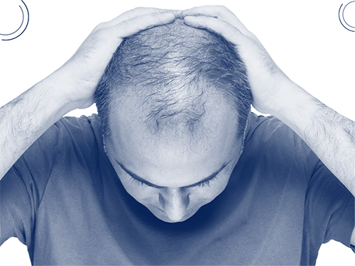 SAÇ DÖKÜLMESİ VE PSİKOLOJİK ETKİLERİ SAÇ DÖKÜLMESİ VE PSİKOLOJİK ETKİLERİ