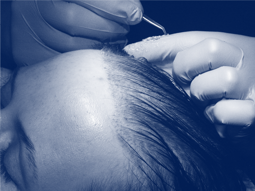 La greffe de cheveux la plus fiable d'Ataşehir Fit Esthetic La greffe de cheveux la plus fiable d'Ataşehir Fit Esthetic