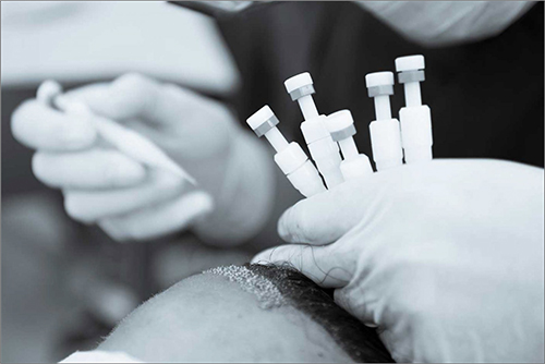 Hair transplantation with the DHI method Hair transplantation with the DHI method