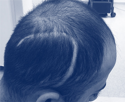 Can Hair Transplant Be Applied To The Injured Area? Can Hair Transplant Be Applied To The Injured Area?