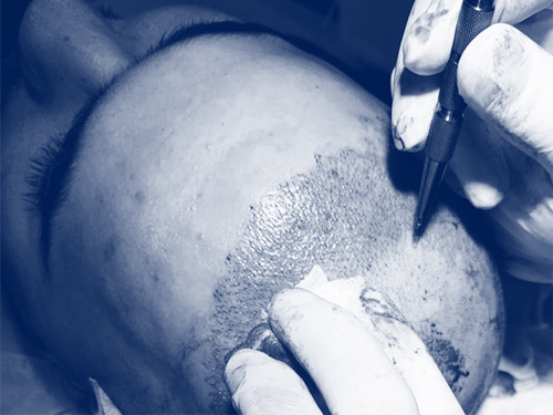 FUE technique for a fast and painless hair transplantation. FUE technique for a fast and painless hair transplantation.