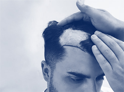 Can Hair Transplantation be Performed on the Burned Area?