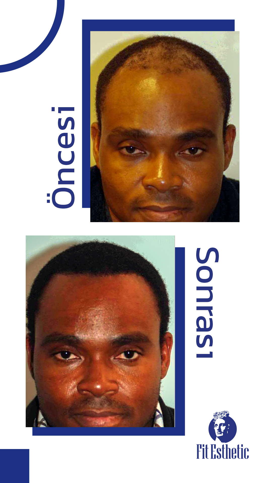 Saç Ekimi Nedir - 1 Saç Ekimi Nedir - 1