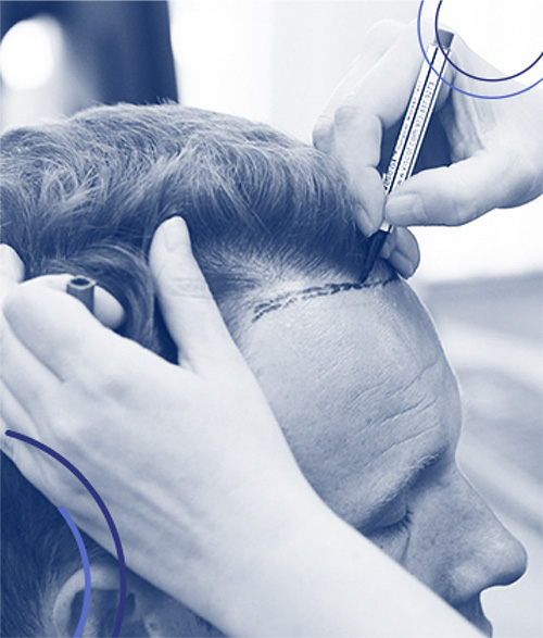 Cos'è la tecnica di trapianto di capelli IceGraft? Cos'è la tecnica di trapianto di capelli IceGraft?