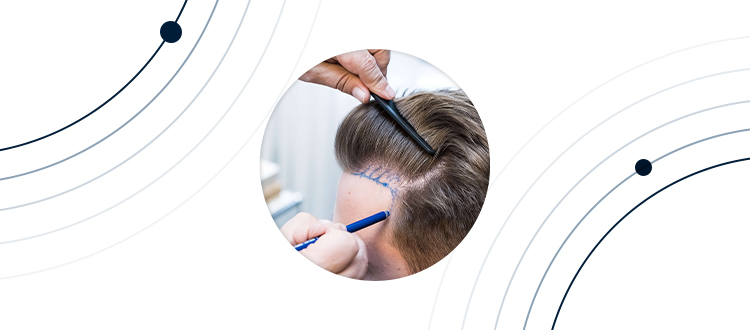 Les méthodes de la greffe de cheveux  Les méthodes de la greffe de cheveux